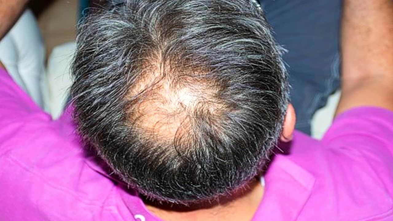 Stop Hair Fall in 2025: New Permanent Solutions That Actually Work!